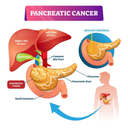glp 1 pancreatic cancer risk GLP-1s tied to lower for 10 types of compared with insulin in type 2 diabetes OR | Early GLP-1 Agonist